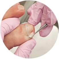 Ingrown Toenail